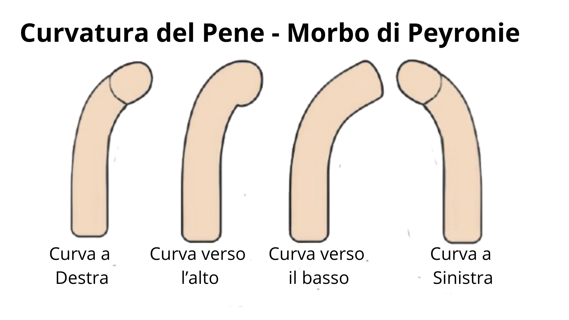 Tipi di curvatura del pene nella malattia di Peyronie